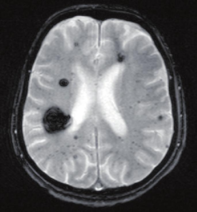 Type II cavernoma in T1-weighted sequence, with central reticular nucleus and a zone of peripheral low-signal