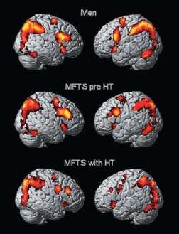 Differential Brain Processing of Audiovisual Sexual Stimuli in men: Comparison