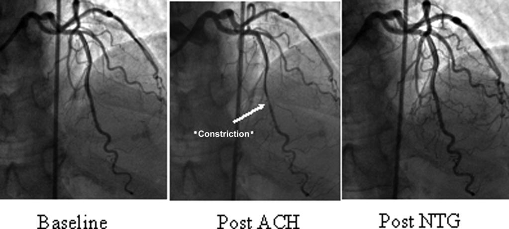 Intracoronary acetylcholine (ACH) demonstrating constriction of the coronary arteries (arrow) and intracoronary nitroglycerin (NTG) coronary angiography