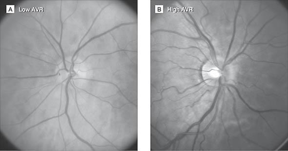 Digitized Retinal Photographs Showing Examples of Low vs High Arteriole-to-Venule