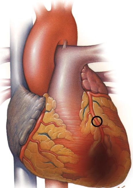 Condition of the Coronary