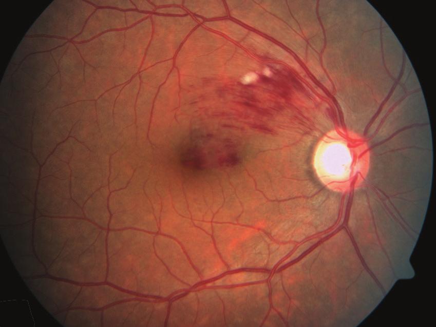 1 2 Figure 1 Branch retinal vein occlusion: Retinal hemorrhage in only a sector of the retina is seen.