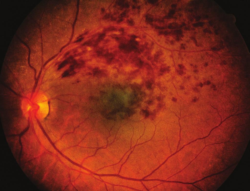 Photo courtesy Anat Loewenstein, MD Figure 2 BRVO with macular edema. David Callanan, MD, Texas Retina Associates. BRVO/CHRPE. Retina Image Bank 2014; Image 15926.