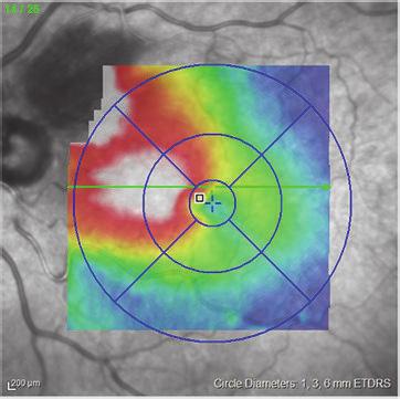 53 (c) (d) Figure 1: (a) Branch retinal vein occlusion prior to therapy. Macular edema is present in the upper half of the macula.