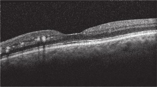 (b) 4 weeks after the loading phase (3 monthly injections of ranibizumab) the edema disappeared. Intraretinal exudates are still present. Central retinal thickness decreased from 331 to 241 μm.