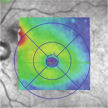 Central retinal thickness is 377 μm. (d) After the loading phase, central retinal thickness remained virtually unchanged. The cystic appearance of the retina is still present.