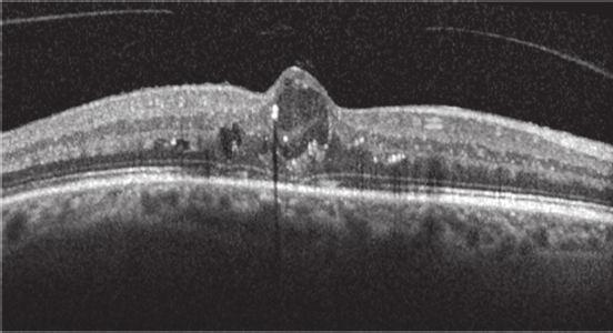30 30 Visual acuity 20 10 OCT central retinal thickness 20 10 0 Responder Low-responder 0 Responder Low-responder Responder month 4 Low-responder month 4 Responder month 4 Low-responder month 4 (a)