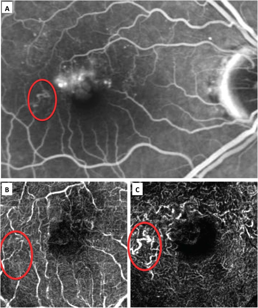 OCT-ANGIOGRAPHY IN BRVO RISPOLI ET AL 2335 Fig. 2. A. Detail of microvasculature anomaly around the FAZ that does not define precisely the layer involved in fluorescein angiography.