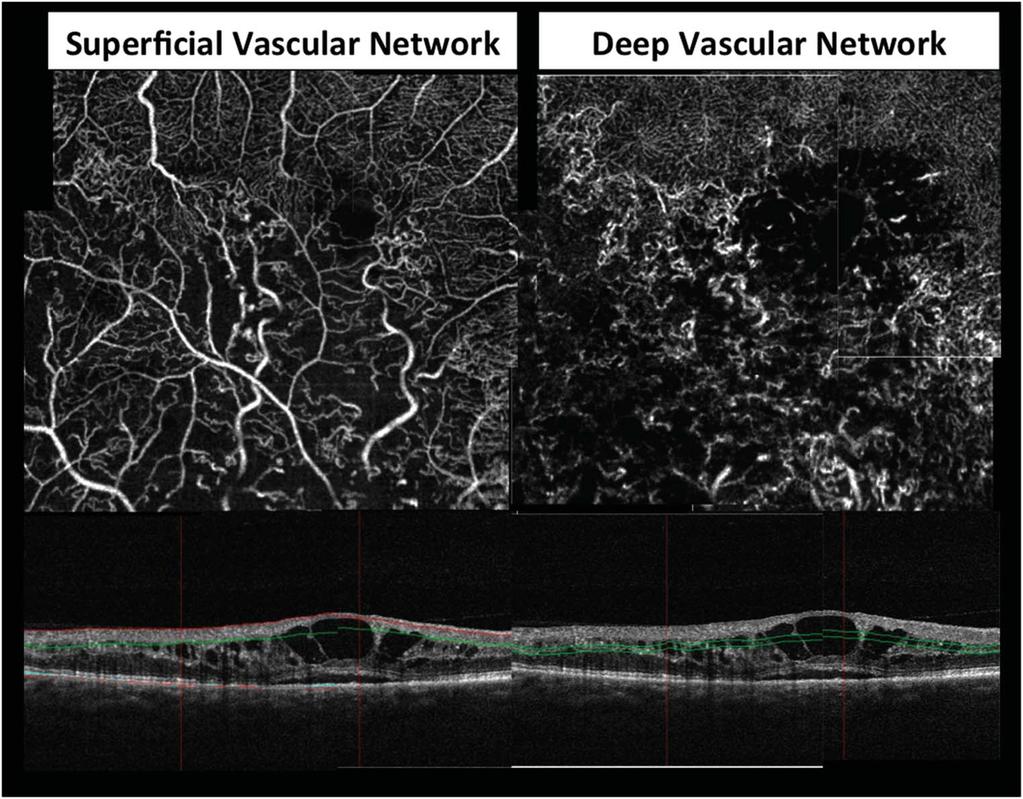 2336 RETINA, THE JOURNAL OF RETINAL AND VITREOUS DISEASES 2015 VOLUME 35 NUMBER 11 Fig. 3. Optical coherence tomography angiography composite of 4-acquisition protocol (3 3) distributed around the fovea.