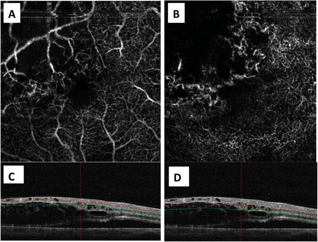 The superficial network reveals sinuous capillary course and multiple intraretinal loops in the area of retina ischemia whereas the deep network presents a full subversion of fan pattern with marked