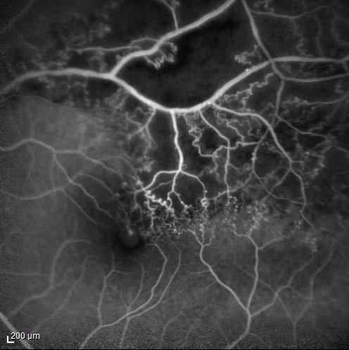 Fluorescein Angiogram Late phase 01:35:48 Widespread