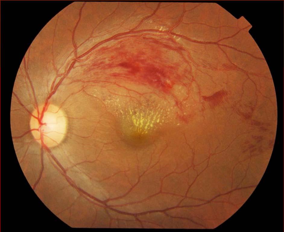 Branch Retinal Vein Occlusion Photo