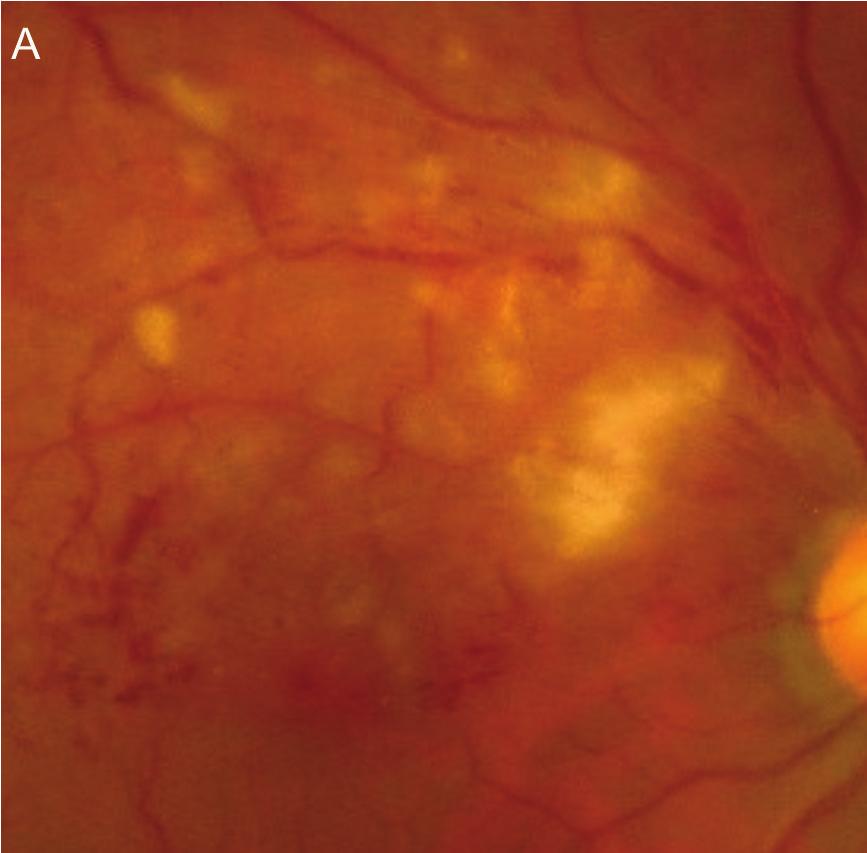 2 Ophthalmology Figure 1: Fundus photograph, OCT, fluorescein angiograph, and autofluorescence