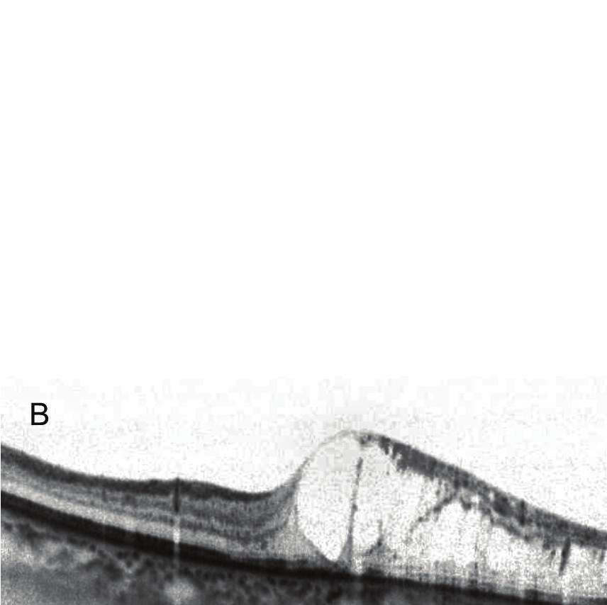 Fluorescein angiography showed a petaloid-shaped hyperfluorescence at the fovea (C).