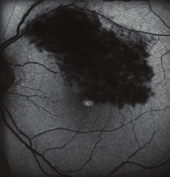 At the first visit At the final visit Serous retinal detachment 24/65 eyes (37%) 1/65 eyes (2%) Defect of the IS/OS line 32/65 eyes (52%) Cystoid changes 65/65 eyes (100%) 34/65 eyes (51%) Not