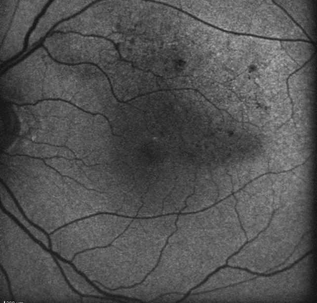 Eyes were excluded if ocular diseases that caused macular edema, such as diabetic retinopathy, central serous chorioretinopathy, and age-related macular degeneration, were present.