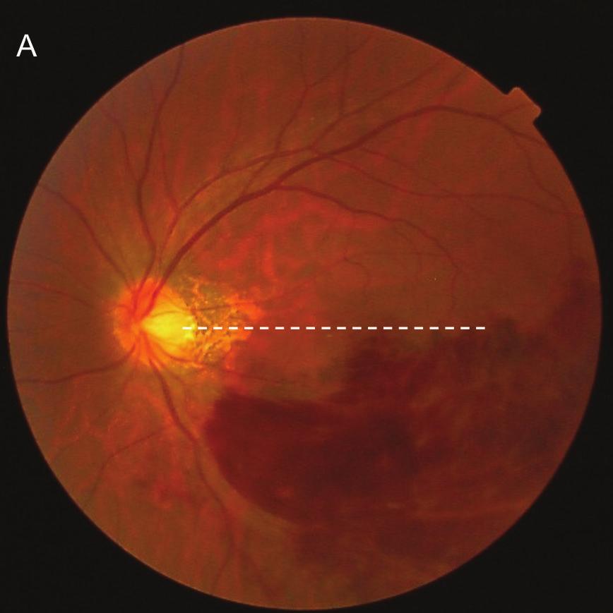 4 Ophthalmology (a) (b) (c) (d) Figure 3: Fundus photograph, OCT, and autofluorescence images for Patient 3 (a