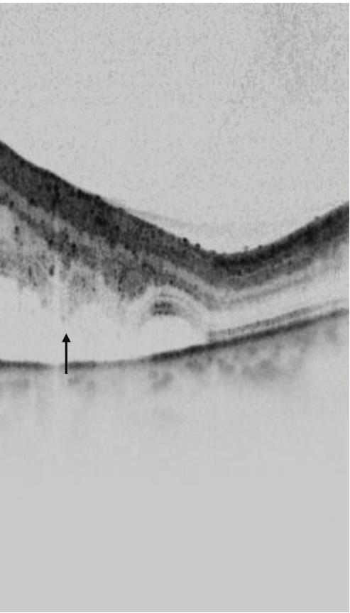 The OCT image (B) showed widespread deposits on the outer surface of the retina (black arrows).
