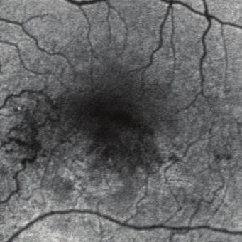 (a2) High magnification image of the fovea. Hyperautofluorescence appeared in the corresponding area of cystoid macular edema (white arrowheads).