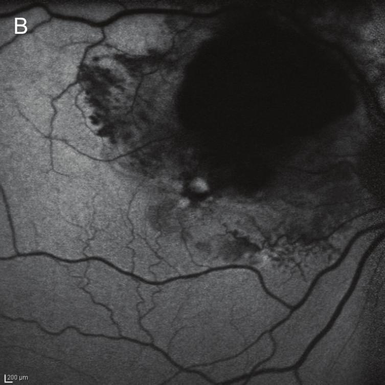 The fundus photograph (A) showed a dense retinal hemorrhage and a