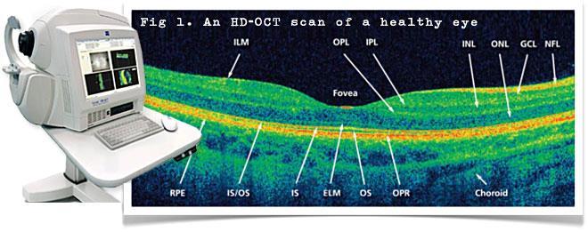 Investigations: Optical Coherence Tomography - Best method - Measures macular oedema, and monitor