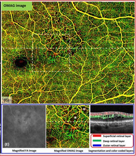 OCT angiography - newer technology can measure vascular density can observe the