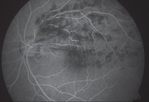 Investigations: Fundal Fluorescein Angiographyinformation on the extent and location of the disease to study the choroidal and retinal