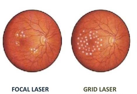 2. Laser