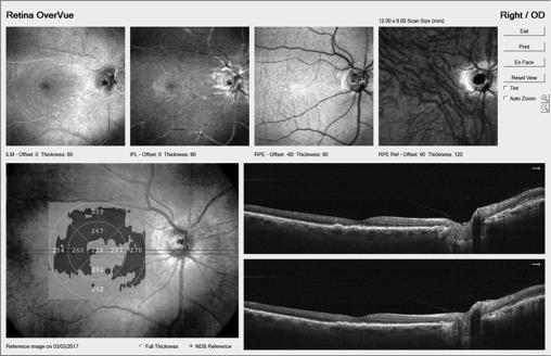 OCT Wet AMD 81 year old male h/o POAG for years T ½ and Latanaprost h/o dry AMD