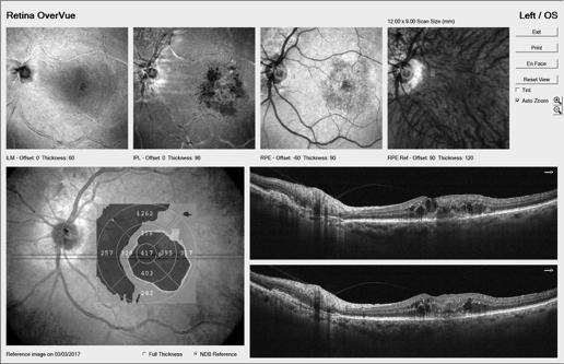 re4nopathy or CSME Wet AMD OCT-Widefield In for 3 mos follow-up Reports lost