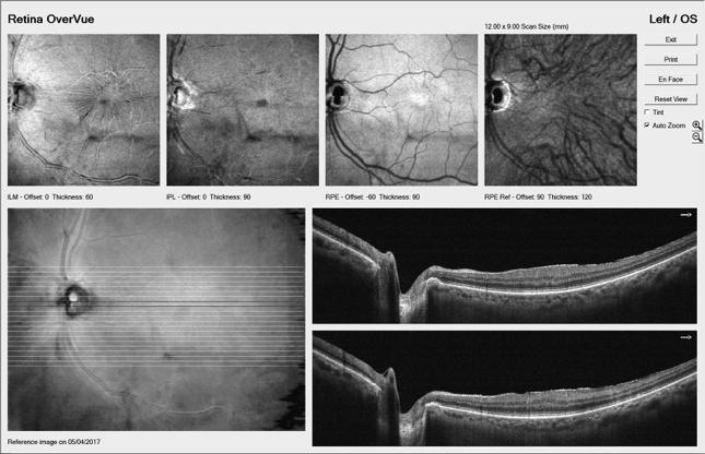 HTN, early cataracts BCVA 20/30 OD 20/20 OS