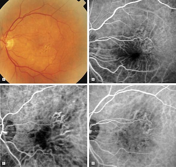 ICG absorbs and fluoresces in the near IR improving choroidal visibility and diffuses more slowly from the