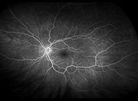 FA is the gold standard for the diagnosis and treatment of retinovascular disease: Diabetic retinopathy (DR) Retinal vein occlusion (RVO) Aged macular