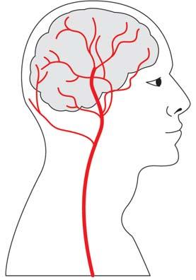 A stroke is a brain injury caused by sudden interruption of blood flow. A stroke is a brain attack A stroke is what happens when the blood supply to part of the brain is cut off.