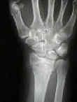 radiocarpal joint Most common