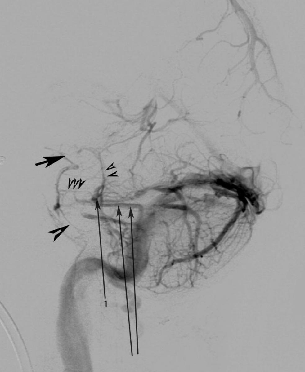 Fig. 4: Lateral Vertebral artery angiogram showing Anterior Confluent Small single Arrow: Anterior pontomesencephalic vein Single Arrow head: Anterior medullary vein