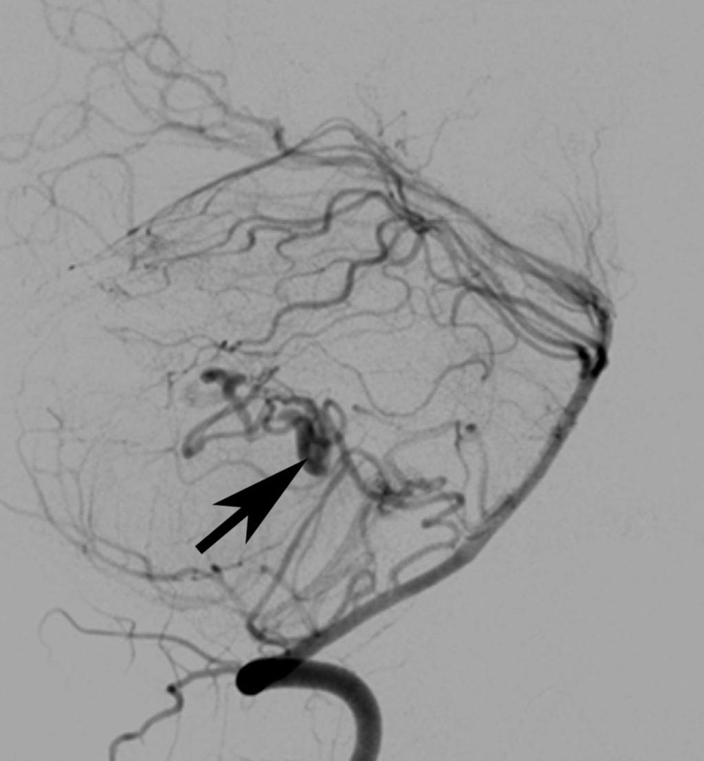 Fig. 6: Lateral view: vertebral artery angiogram