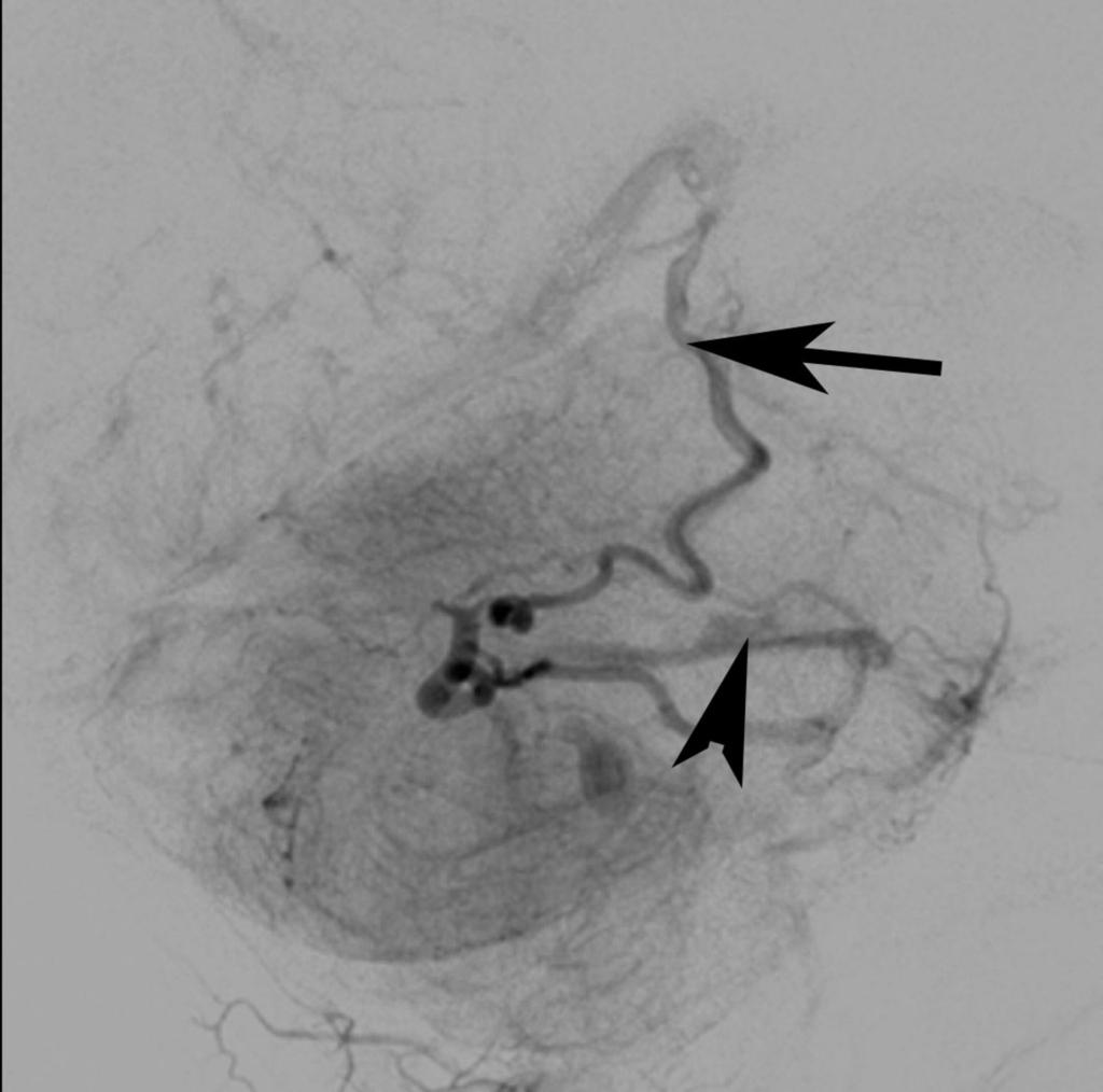 Fig. 7: Lateral view: Vertebral artery angiogram showing PICA feeding right hemispheric and vermian