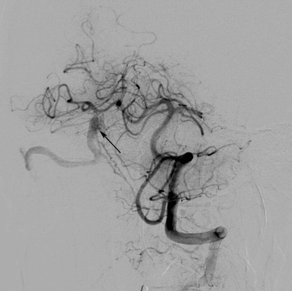 Fig. 13: Lateral veiw vertebral angiogram