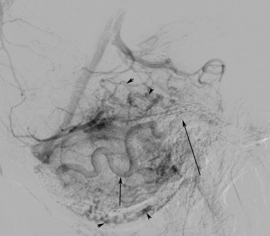 Fig. 14: Lateral View vertebral angiogram showing Arrow: Hemispheric vein Long