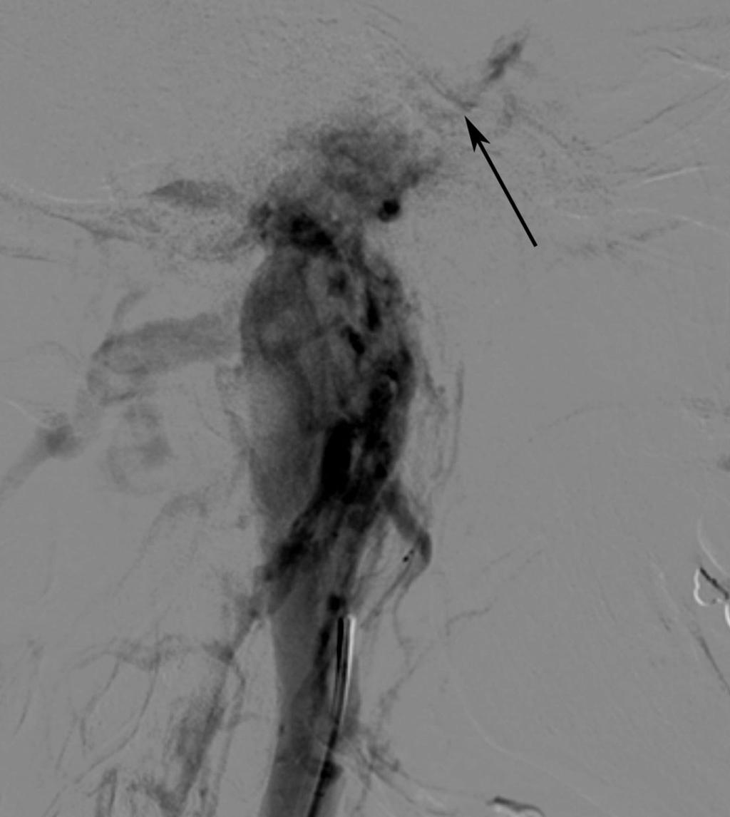 Fig. 16: lateral view angiogram AP view angiogram showing glomus jugulare tumour draing into jugular vein,