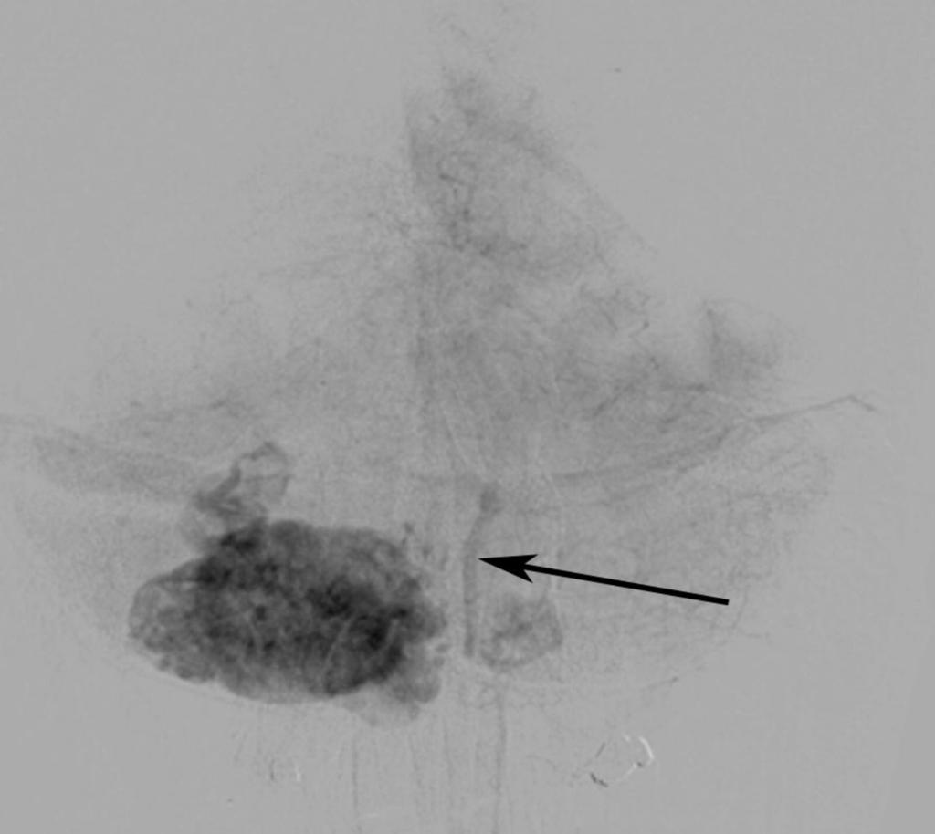 Fig. 17: AP View Angiogram showing intensely enhancing mass within