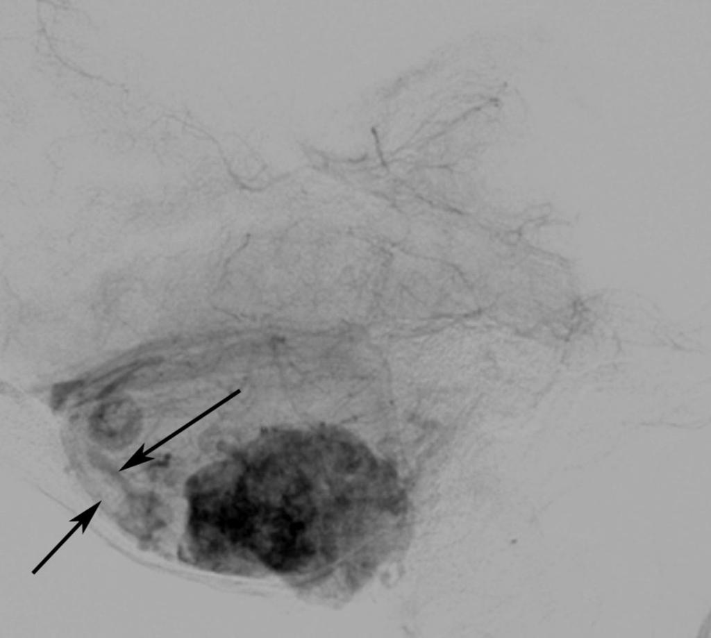 Fig. 18: Lateral view Angiogram showing intensely enhancing mass