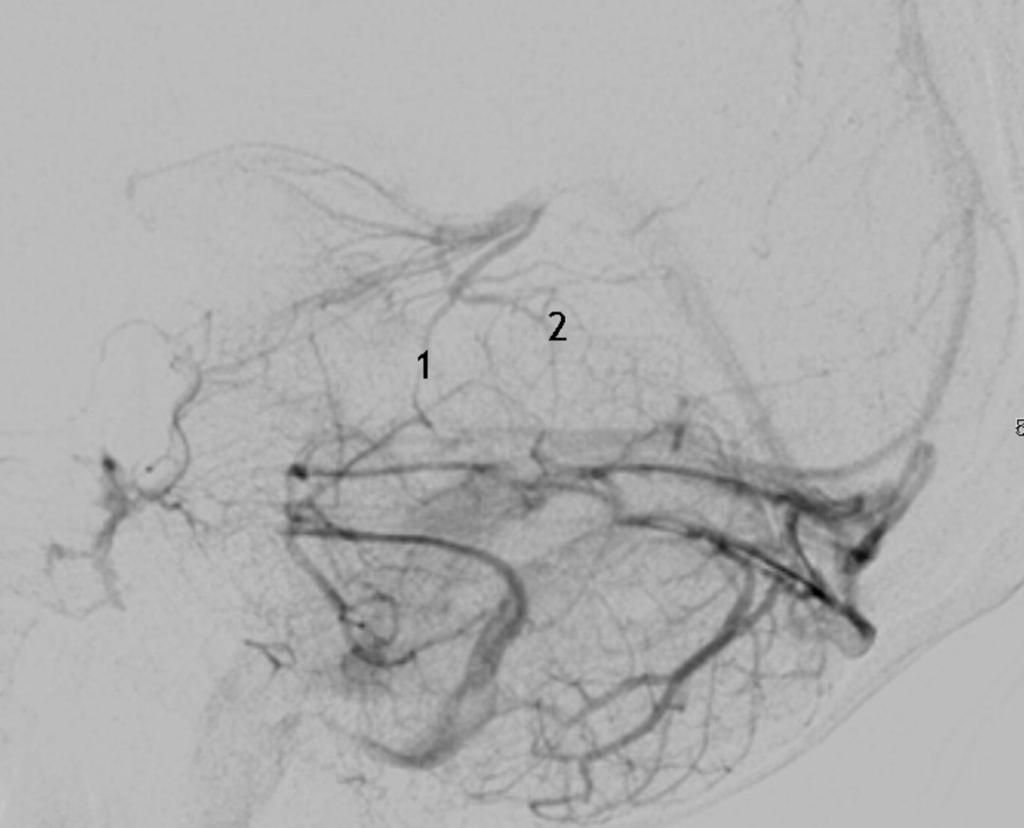 Fig. 1: Lateral view vertebral artery angiogram showing