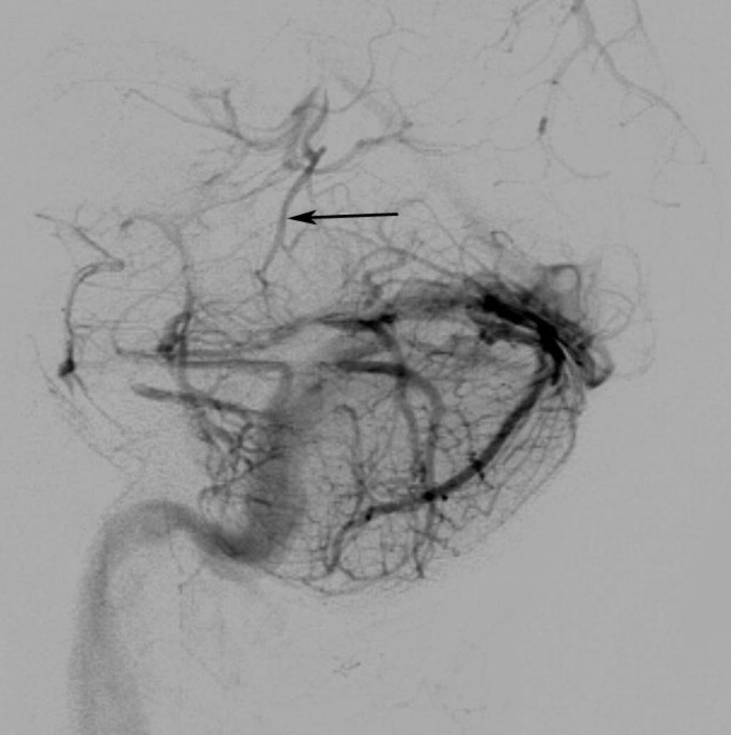 Fig. 2: lateral vertebral artery angiogram
