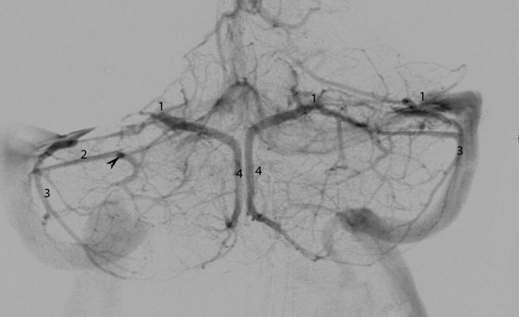 Fig. 3: AP view vertebral angiogram showing anterior and posterior confluence 1. Tentorial sinus 2.