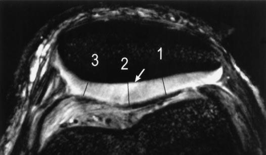 a. c. b. Figure 2. Pattern 1. Focally increased T2 limited to the radial zone in a 42-year-old man with intermittent anterior knee pain.