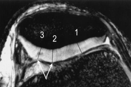 a. c. b. Figure 3. Pattern 2. Heterogeneously increased T2 extending to the surface in a 45-year-old woman with recurrent anterior knee pain and joint effusion.