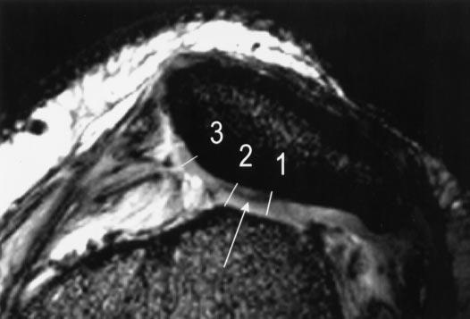 a. Figure 4. Pattern 3. Focal increased T2 associated with a flap tear extending to the radial zone in a 34-year-old woman with intermittent anterior knee pain.