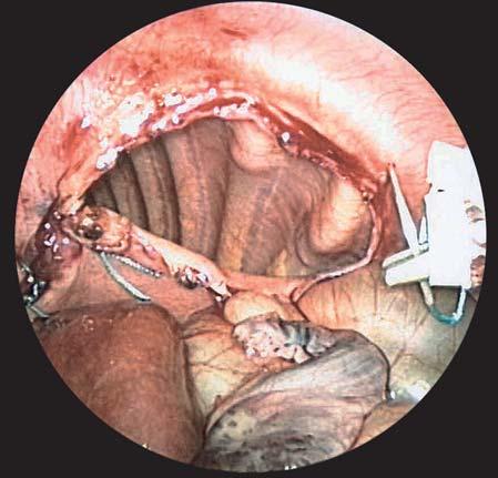 Chapter 75 Laparoscopic Repair of Diaphragmatic Defects: Congenital Diaphragmatic Hernia and Eventration 571 Technique Cannulae Cannula Method of insertion Diameter (mm) Device Position 1 Closed